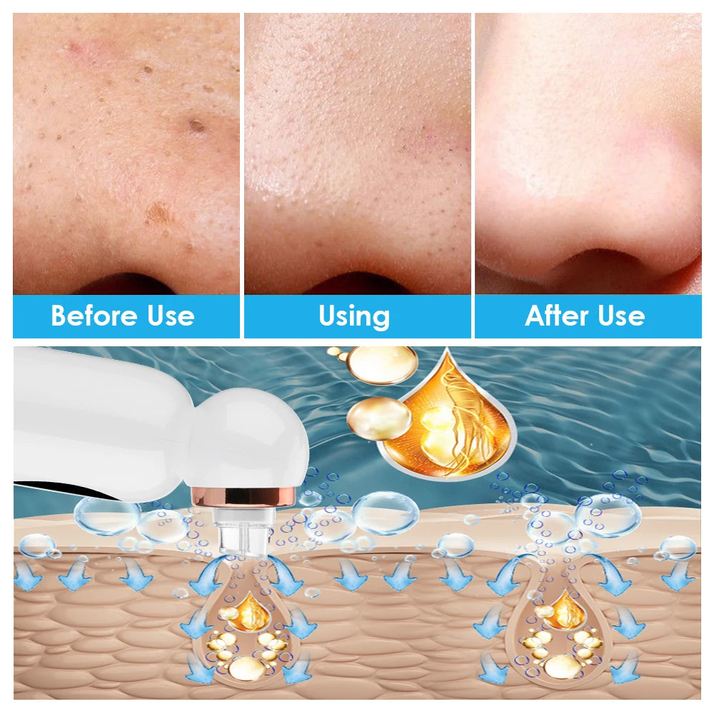 Bloovely - Pulitore Viso Aspiratore Punti Neri Acne