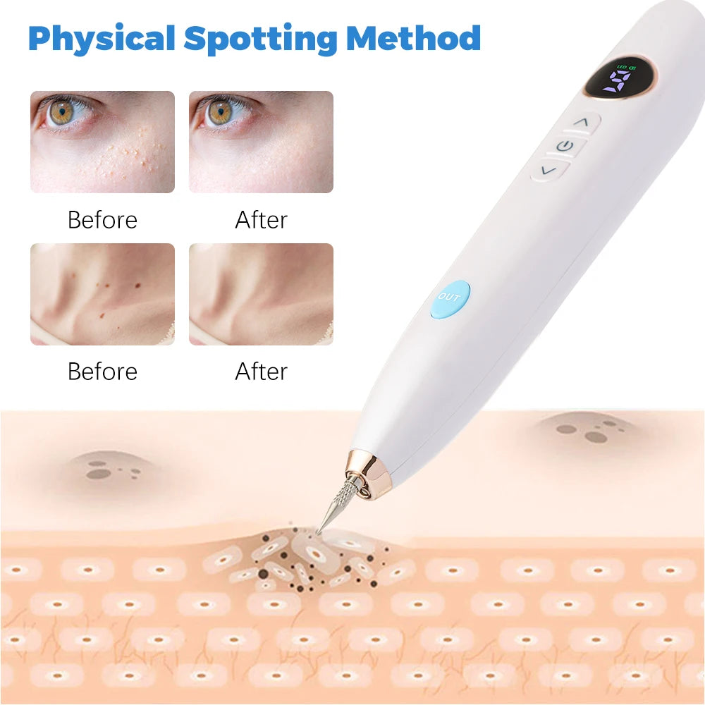 Bloovely - Penna Laser Rimozione Verruche e Papillomi